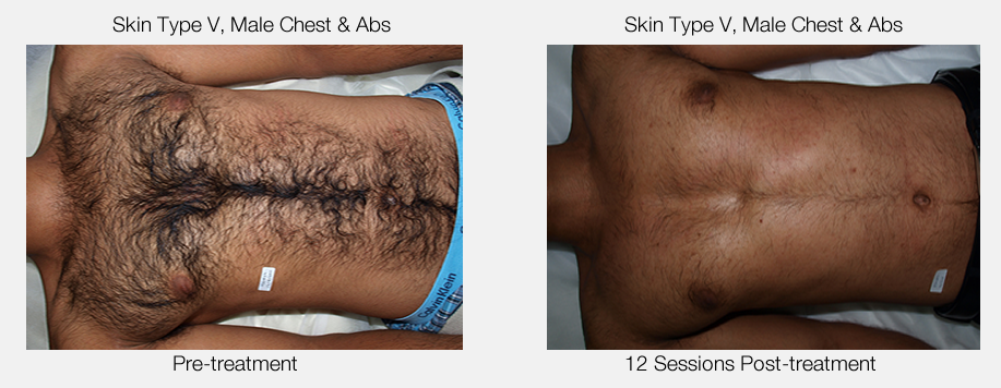 laser hair removal singapore