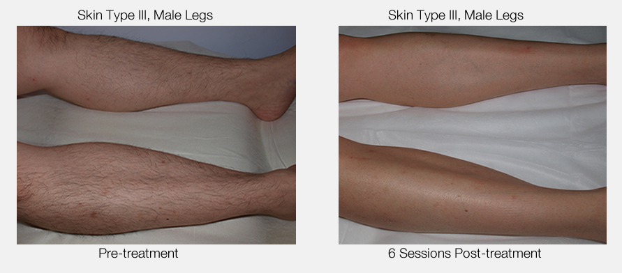 Permanent leg hair removal new arrivals